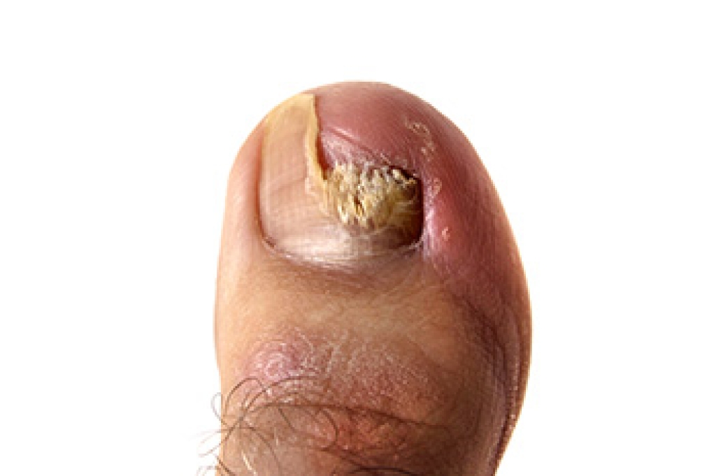 Persistent Toenail Fungus Explained