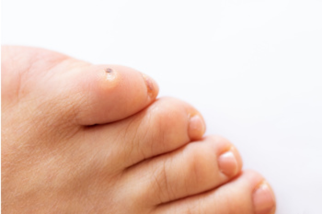 Recognizing Early Symptoms of Foot Corns