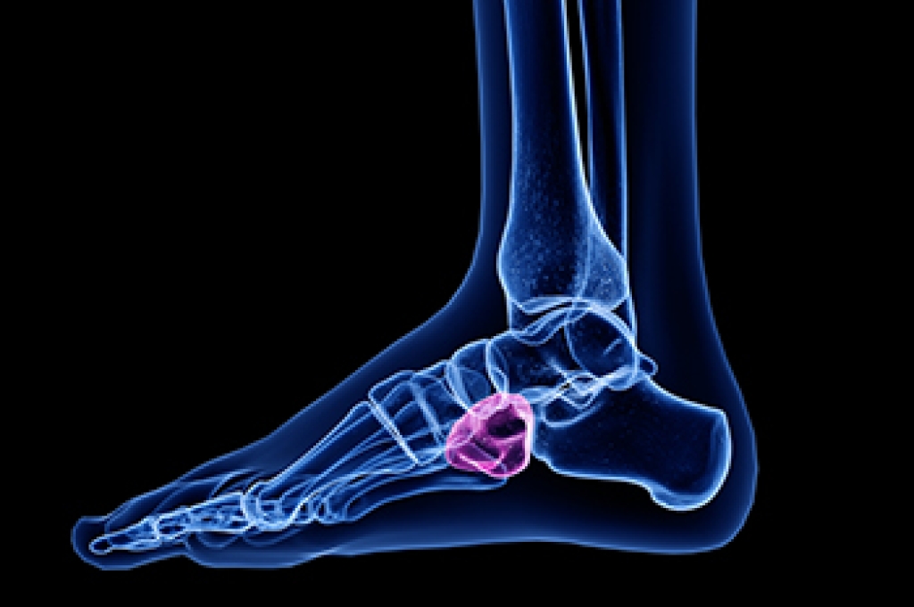 Guide to Podiatric Care for Cuboid Syndrome