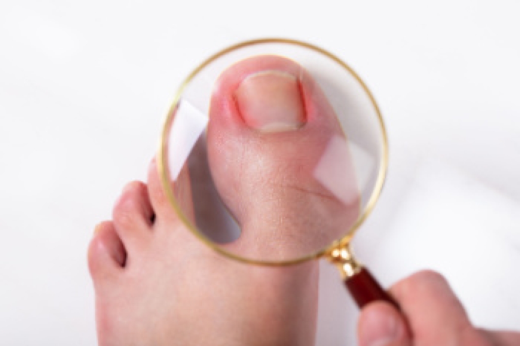 Definition and Causes of Ingrown Toenails
