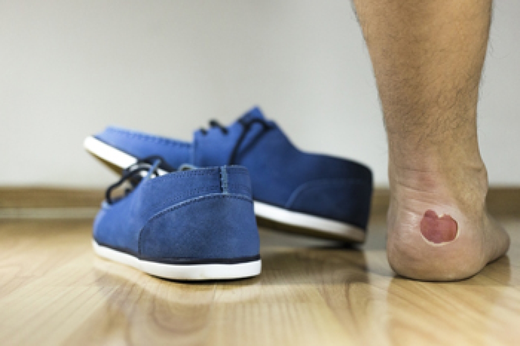 Understanding Foot Blisters and Their Causes