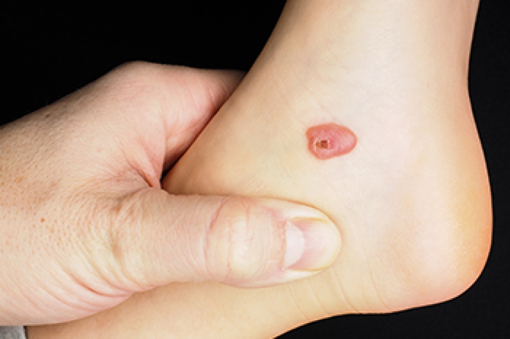 Blistering Foot Lesions in Older Adults