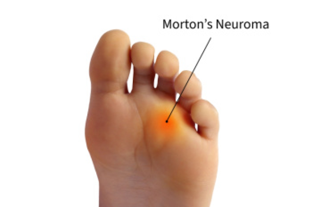 Burning Pain Between the Toes