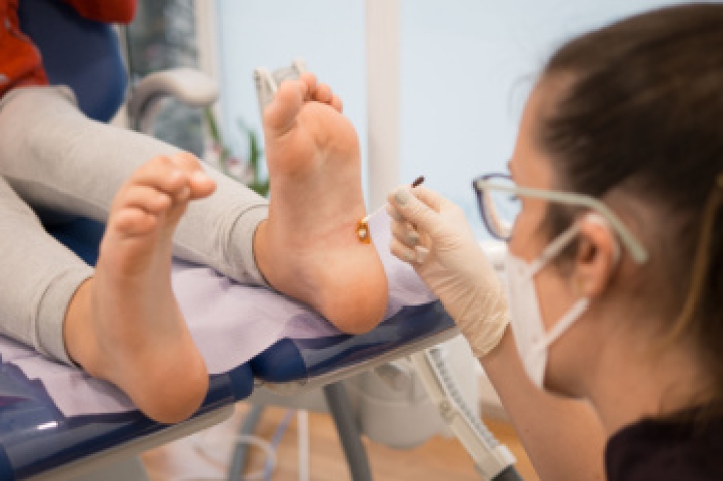 How a Podiatrist Treats Painful Plantar Warts