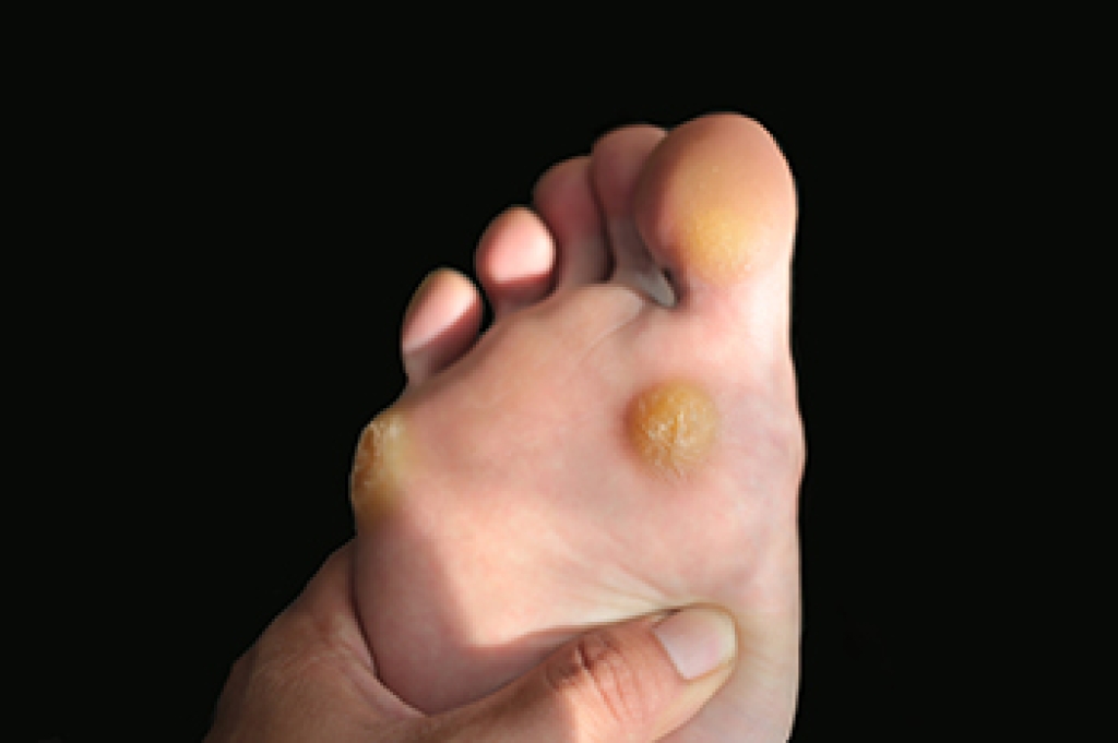 Pachyonychia Congenita and How It Affects the Feet