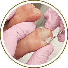 Ingrown Toenails treatment in the Washington County, UT: St. George (Santa Clara, Ivins, Shivwits, Hurricane, Leeds), Kane County, UT: Kanab (Mt Carmel Junction), and Clark County, NV: Mesquite (Bunkerville) areas