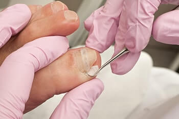 Ingrown toenails treatment in Washington County, UT: St. George (Santa Clara, Ivins, Shivwits, Hurricane, Leeds), Kane County, UT: Kanab (Mt Carmel Junction), and Clark County, NV: Mesquite (Bunkerville)