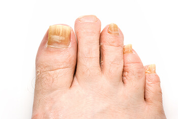 Fungal toenails treatment in the Washington County, UT: St. George (Santa Clara, Ivins, Shivwits, Hurricane, Leeds), Kane County, UT: Kanab (Mt Carmel Junction), and Clark County, NV: Mesquite (Bunkerville) areas