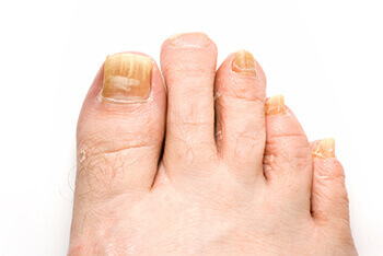 Fungal toenails treatment in the Washington County, UT: St. George (Santa Clara, Ivins, Shivwits, Hurricane, Leeds), Kane County, UT: Kanab (Mt Carmel Junction), and Clark County, NV: Mesquite (Bunkerville) areas