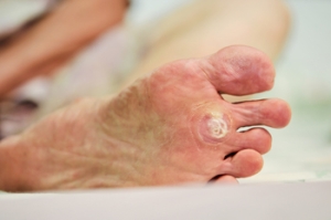 Plantar Wart Treatment and Prevention