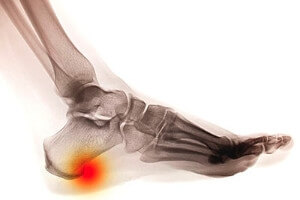 Heel Spur Symptoms